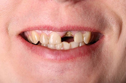 Before Treatment