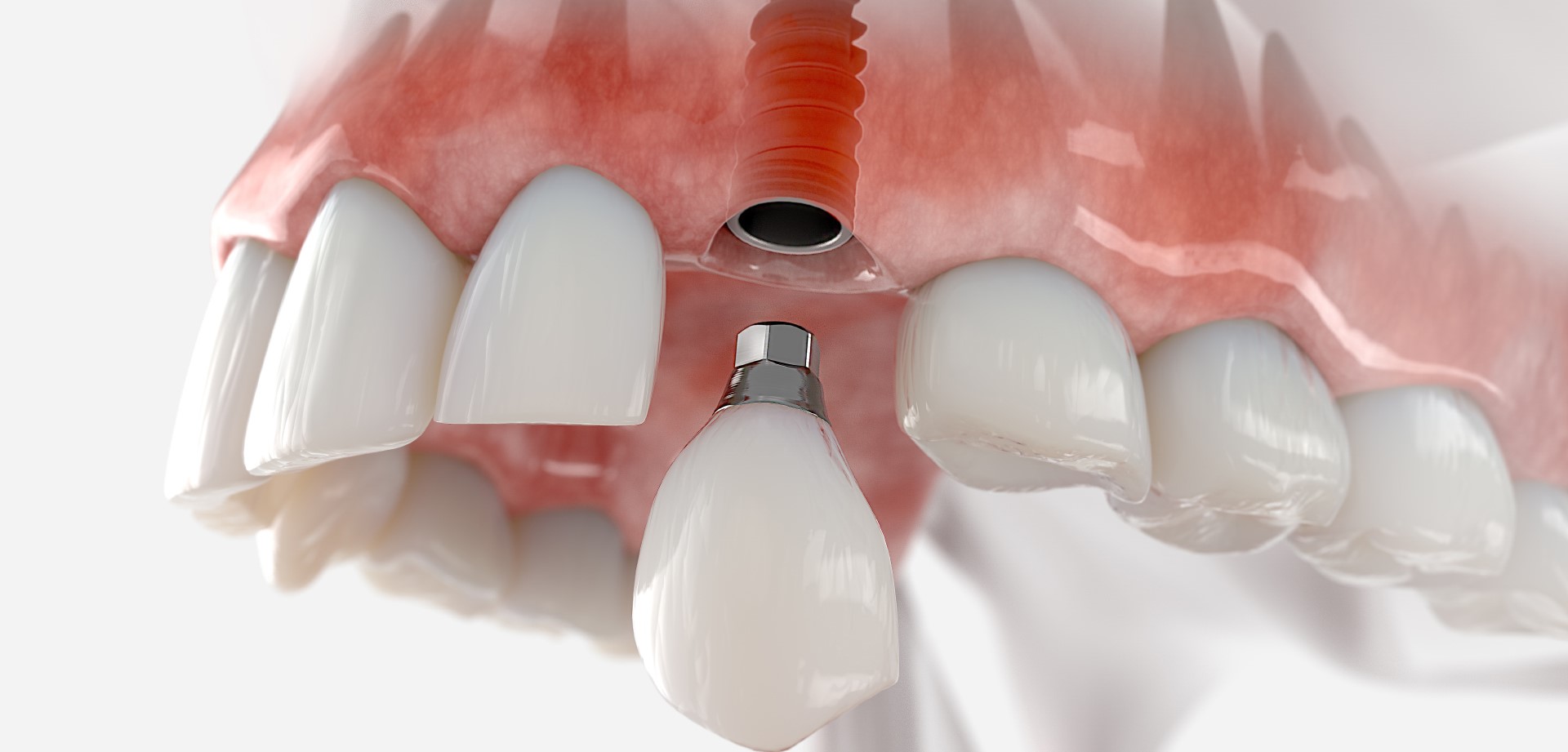 Fixed Dentures