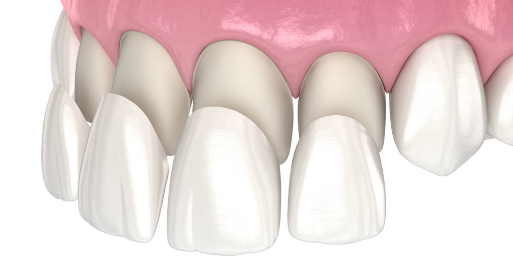 Veneers