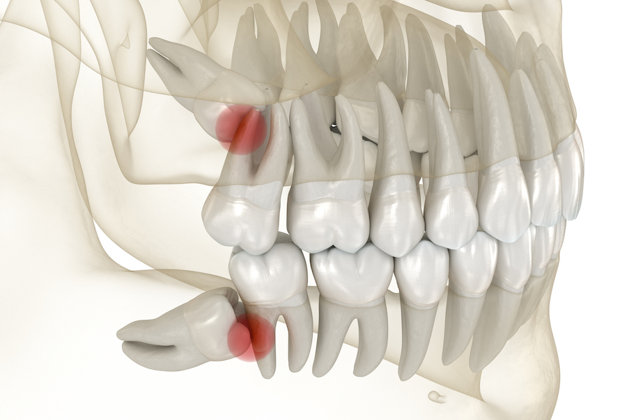 Odontectomy and Other Minor Surgeries